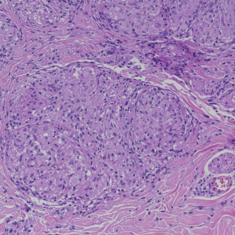“Naked” granuloma is sharply defined with sparse lymphocytes and no necrosis, consistent with sarcoidal granuloma (H&E, ×400)