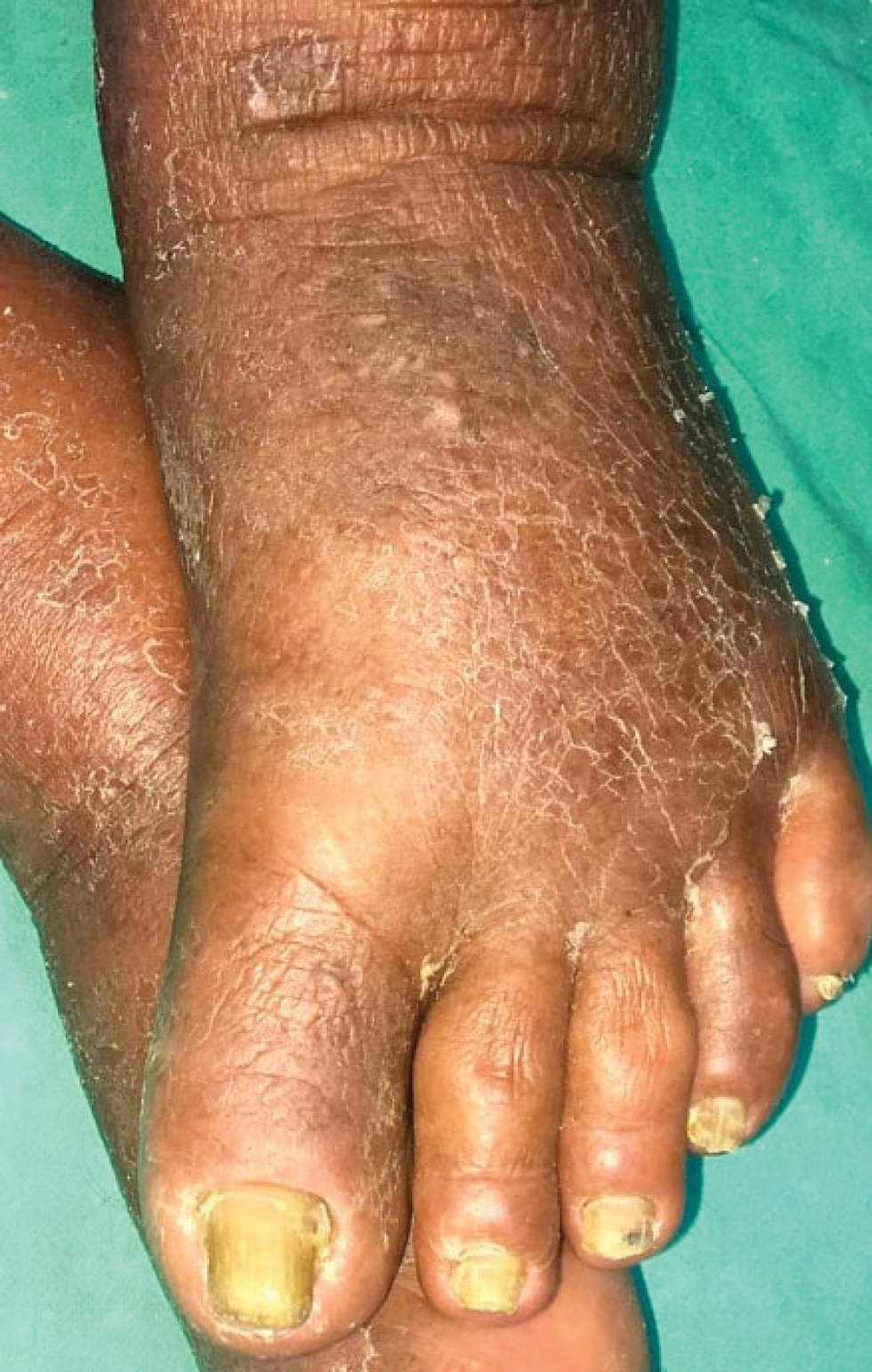 Bilateral pedal oedema with overlying diffuse erythema and scaling