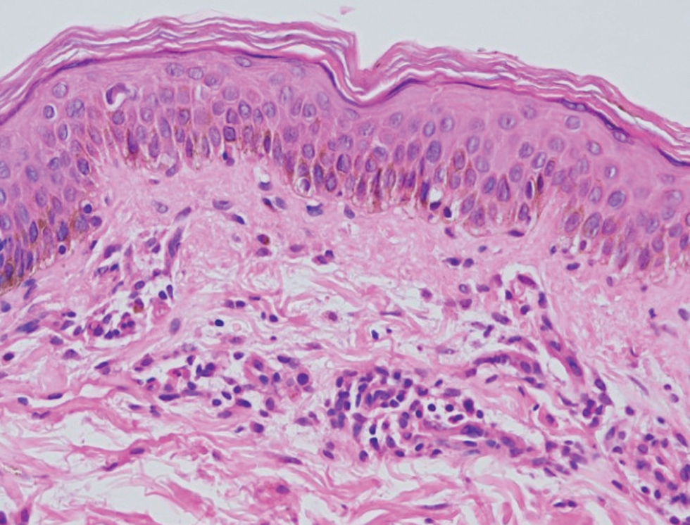 The skin biopsy shows hyperkeratosis and superficial dermal mild perivascular infiltrate of lymphocytes and occasional eosinophils (Haematoxylin and eosin, ×;400)