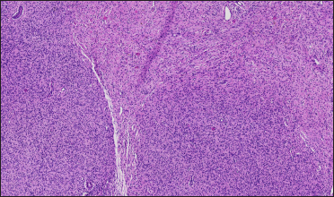 Histopathology of a subcutaneous mass on the posterior back of the proband (H&E, ×40). Tumours formed by spindle cells were found in the dermis, involving subcutaneous adipose tissue and unclear boundaries. Spindle cell cytoplasm is not obvious, nucleus spindle or oval