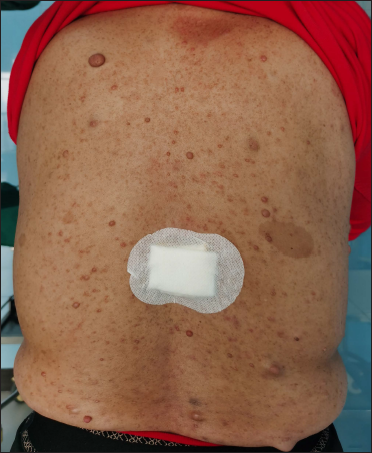 A 52-year-old woman with neurofibromatosis type 1. Cutaneous neurofibroma of various sizes on the back (a) and freckles in the armpit