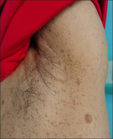 A 52-year-old woman with neurofibromatosis type 1. Cutaneous neurofibroma of various sizes on the back (b) of the proband’s mother