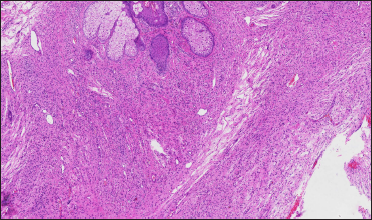 Histopathology of a cutaneous neurofibroma on the back of the mother (H&E, ×40). The tumours formed by spindle cells have unclear boundaries, unobvious cytoplasm of spindle cells, and spindle or oval nuclei