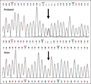 Nonsense mutation c.T1664>G (position indicated by arrow) in the proband, but not in the sister