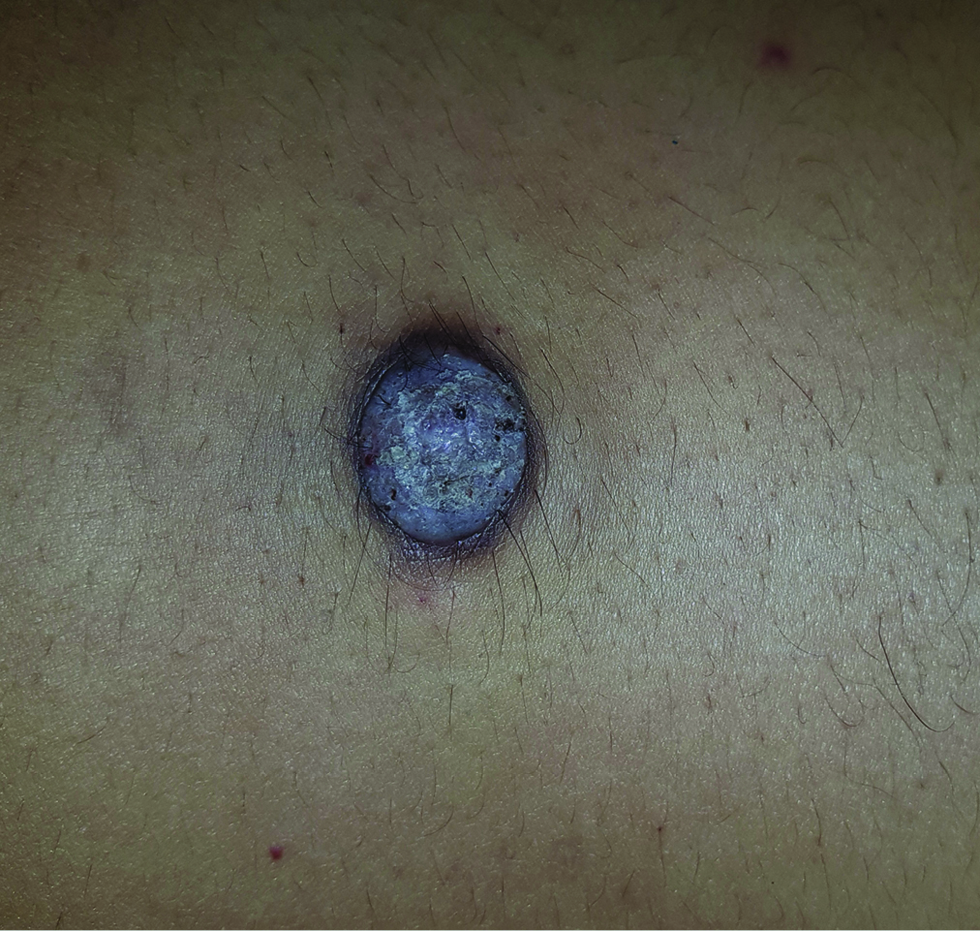 Hyperpigmented nodule on the left flank