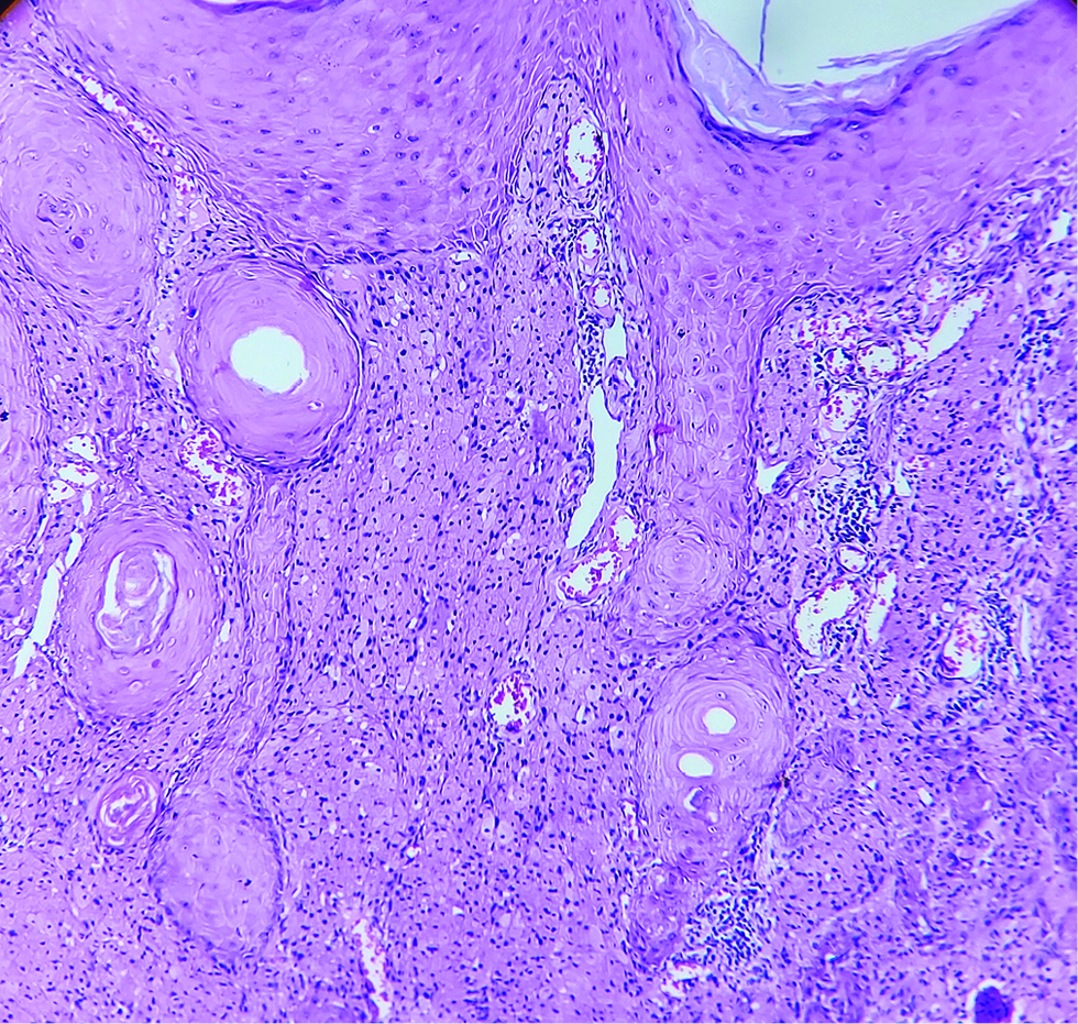 Well-circumscribed diffuse dense and nodular proliferation of large cells (H and E, × 100)