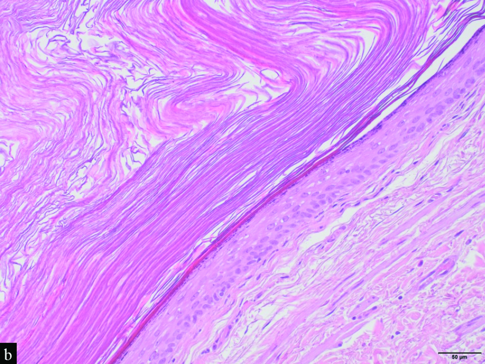 Detail of the cystic wall, which is lined by a stratified squamous epithelium with a granular layer. Note the laminated keratin within the cyst (H&E, x20)