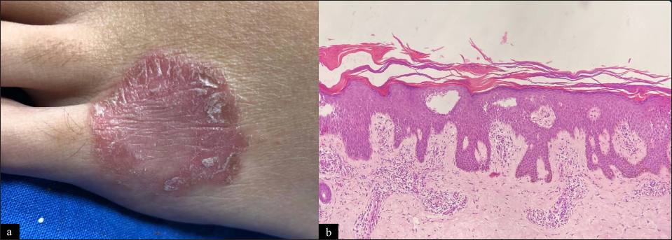 Psoriasiform fixed drug eruption: (a) Single well-defined erythematous scaly plaque over dorsum of the left foot 12 days after ingestion of diclofenac tablet for tooth ache. Patch test carried out at same site four weeks after resolution was positive confirming diagnosis. (b) Hyperkeratosis with parakeratosis with acanthosis and regular elongation of rete ridges. Suprapapillary thinning and dilated capillaries in the papillary dermis (H and E, ×100)