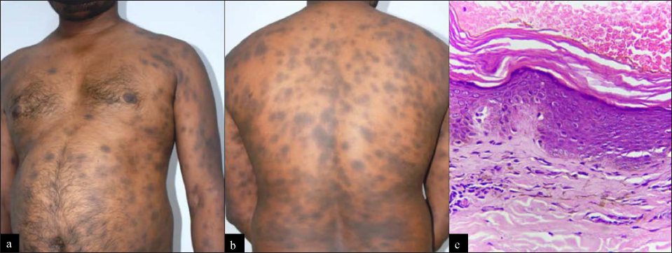 Erythema dyschromicum perstans-like fixed drug eruption: (a and b) Multiple violaceous plaques with erythematous borders present over trunk and back. History of recurrent episodes of eruption after ingestion of ofloxacin-ornidazole combination for loose stools was elicited. (c) Photomicrograph shows interface dermatitis with basal cell layer vacuolization. Marked pigmentary incontinence in the papillary dermis also present with mild inflammatory infiltrate (H and E, 100×)