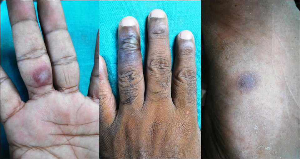 Bullous fixed drug eruption: Multiple bullae with surrounding erythema present over palm, dorsum of hand and trunk in a 35-year-old, two days after ingestion of azithromycin. The previous history of violaceous eruption after ingestion of azithromycin was present. Current episode led to bullous lesions