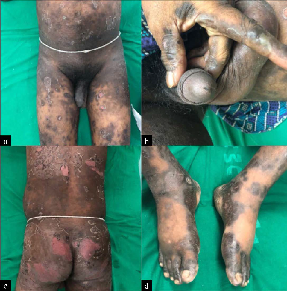 Generalised bullous fixed drug eruption within 1 day after ingestion of ibuprofen tablet: (a) Areas of post inflammatory hyperpigmentation and erosions over the perineum, thighs and genitalia, (b) blisters and hyperpigmentation over genitalia and hands, (c) erosions, scaling and pigmentation over the back and buttocks and (d) blisters and pigmentation over the legs