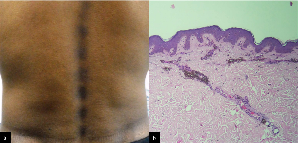 Linear fixed drug eruption: (a) Multiple hyperpigmented patches arranged in a linear distribution on the back of a patient. History of consumption of azithromycin tablet 20 days ago for sore throat was present. History of similar lesions after intake of azithromycin for acne vulgaris one year ago. (b) Photomicrograph depicts basal layer hyperpigmentation, mild interface dermatitis, pigment incontinence and perivascular infiltrate (H and E, ×100)