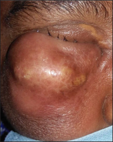 A large contiguous abscess of size 6 × 8 cm over right cheek and ipsilateral eyelids