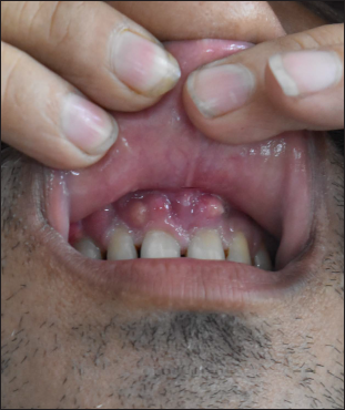 Multiple gingival pustules on the upper gingiva (anterior aspect)