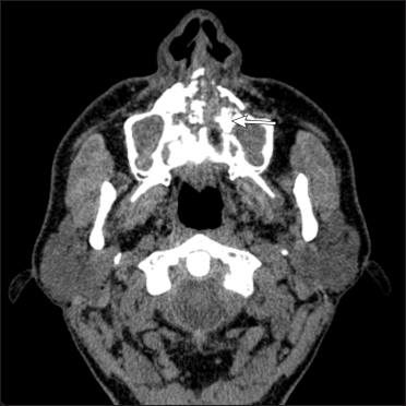 Corresponding axial non contrast CT scan shows bilateral maxillary sinusitis with moth-eaten erosion of hard palate
