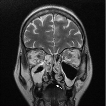 Corresponding coronal T2 weighted MR image shows focal defect in the hard palate (arrow) with bilateral maxillary, ethmoid sinusitis and orbital cellulitis