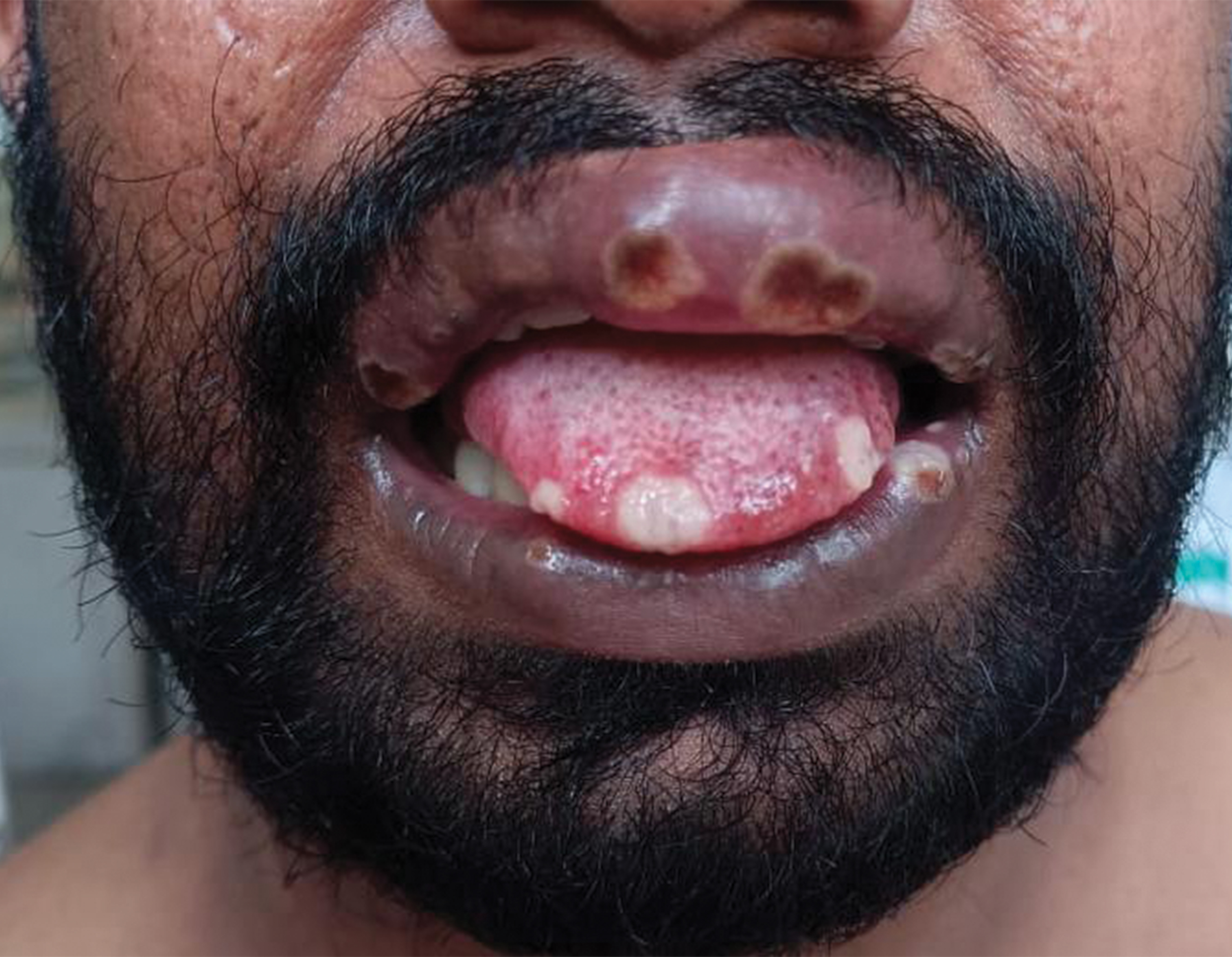 Monkeypox. Day-7. Upper lip oedema with well-defined erosions with slough