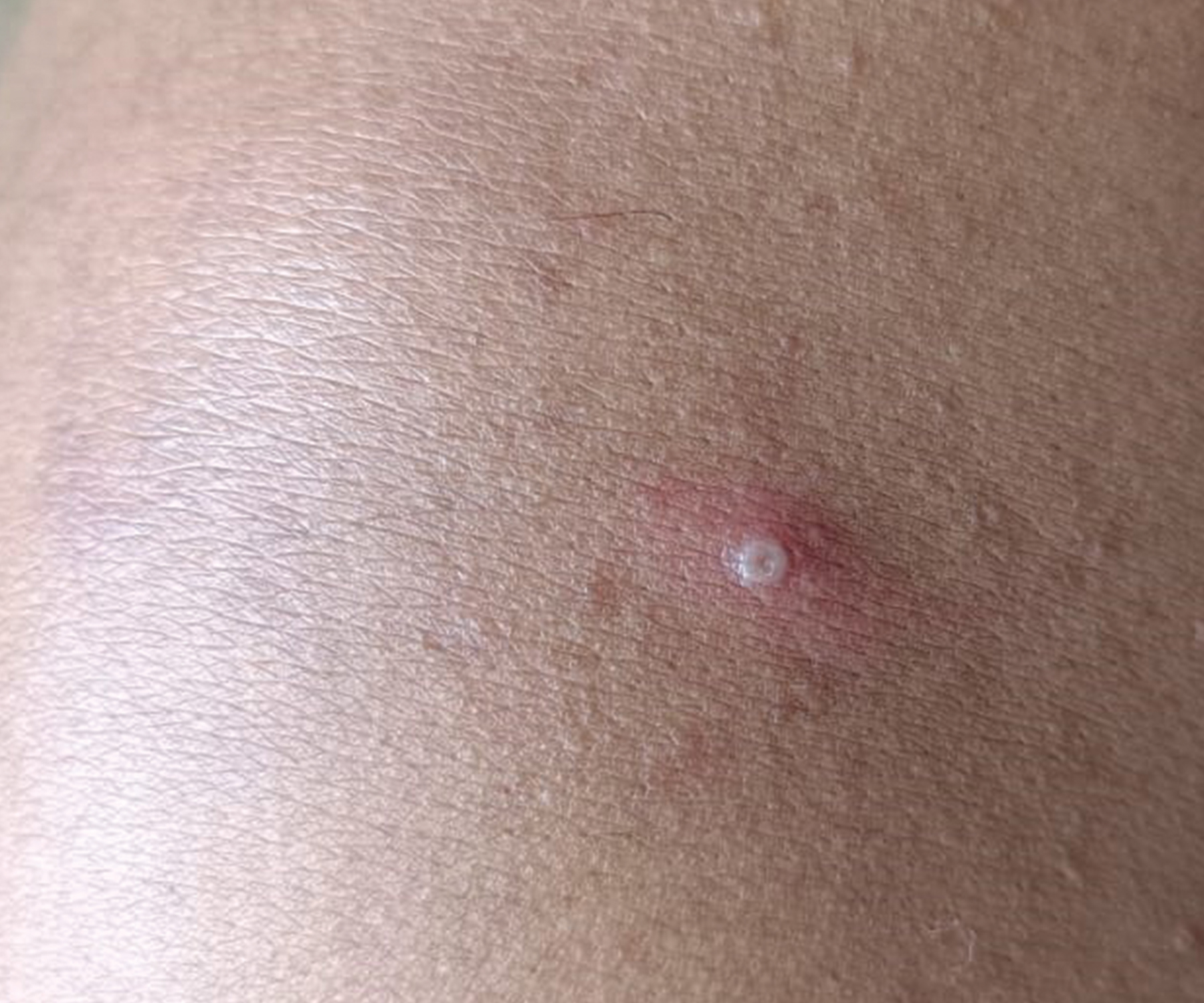 Monkeypox. Day-10. Pustule on shoulder with central umbilication