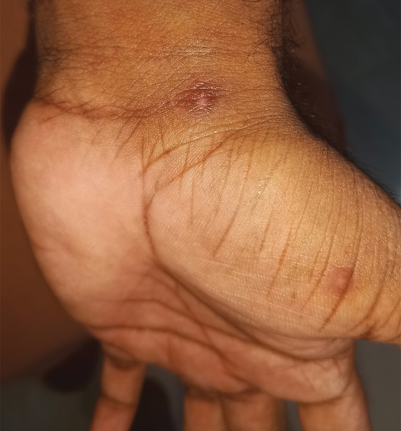 Monkeypox. Day-23. Healed lesion on palm, with central atrophy and hypopigmentation; peripheral hyperpigmentation