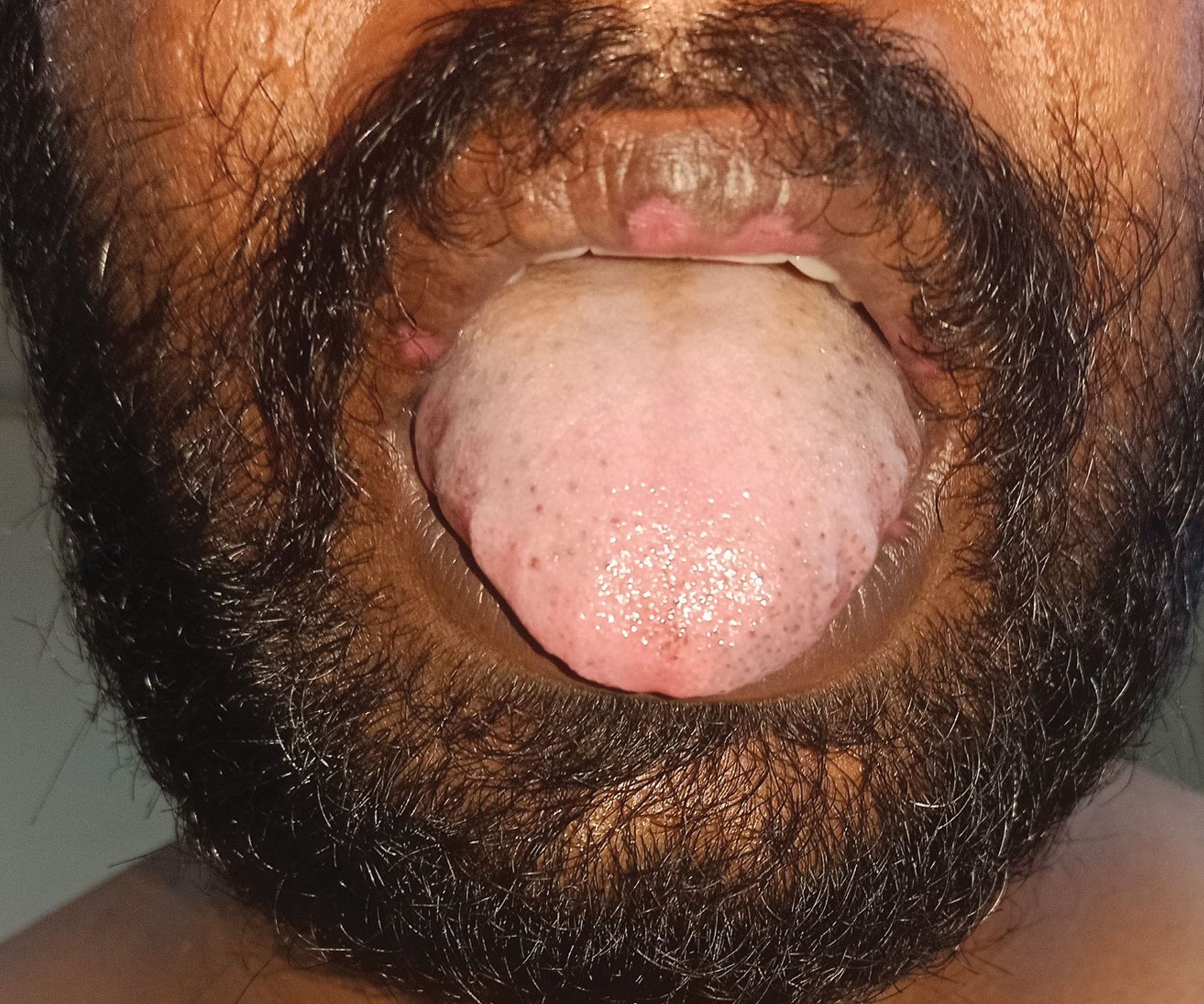 Monkeypox. Day-23. Healed lesions on lips with central atrophy and hypopigmentation; peripheral hyperpigmentation