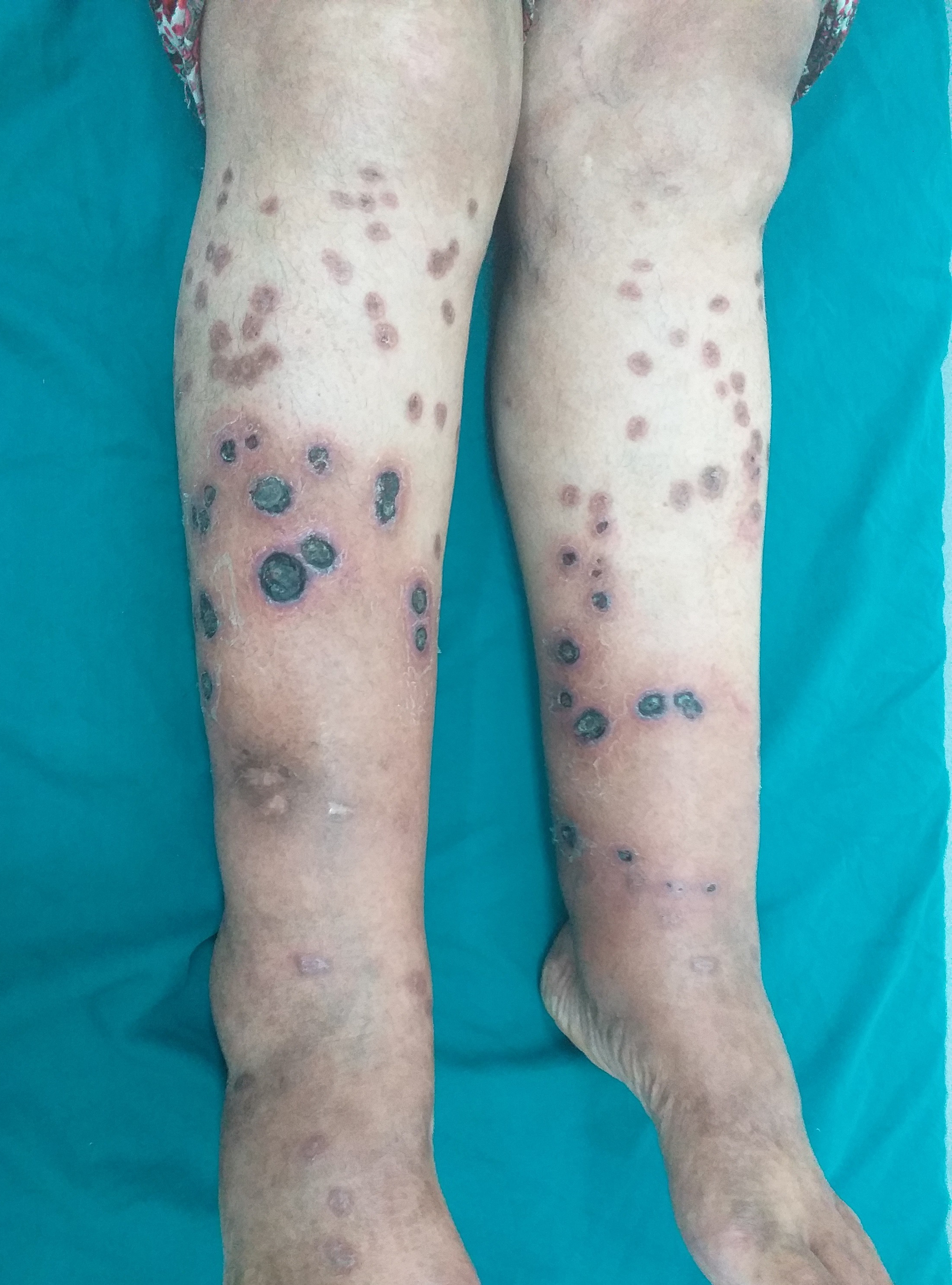 Granulomatous tattoo reaction treated with topical allopurinol