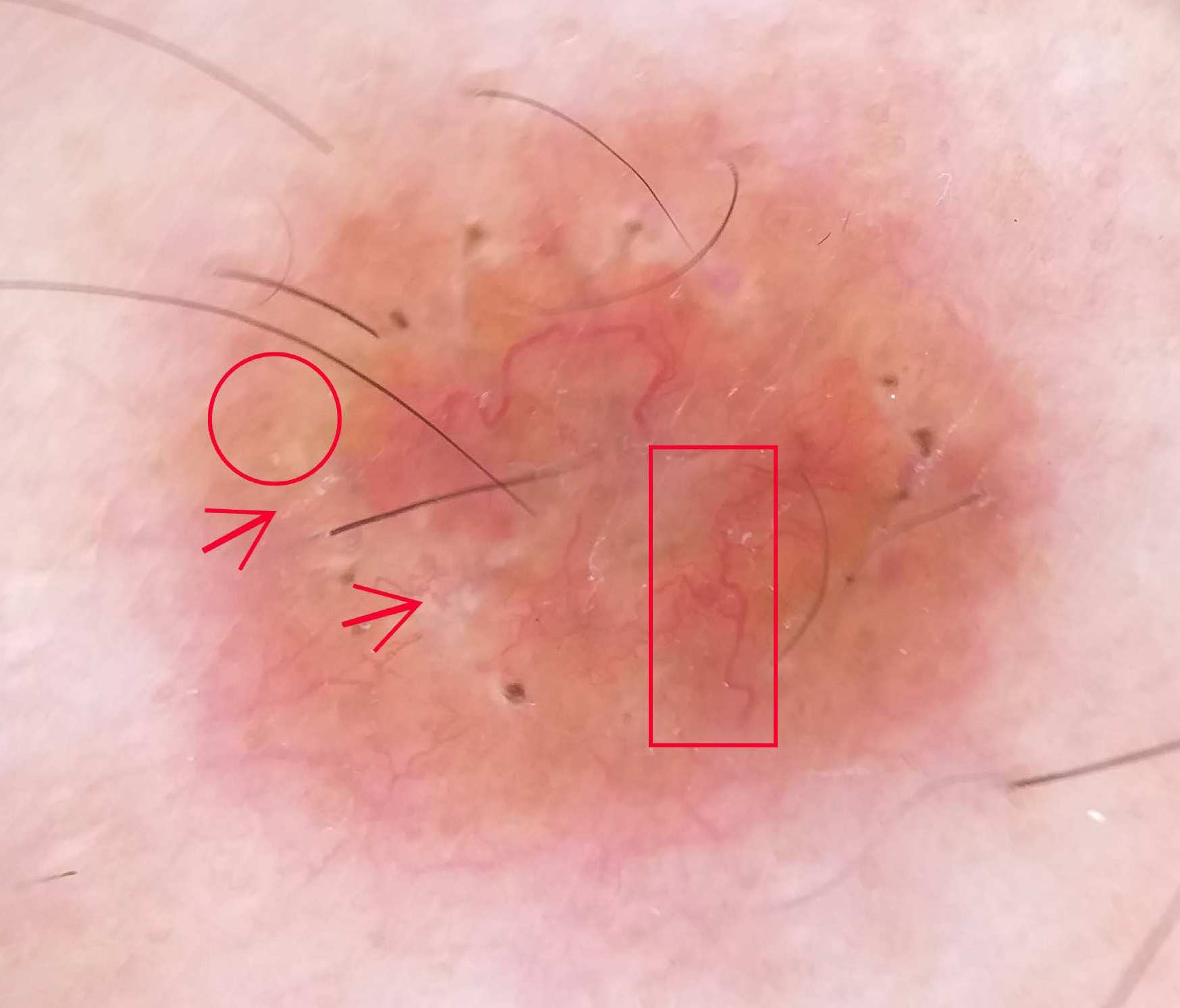 Dermoscopic examination revealed multiple linear and branching vessels (red rectangle) overlying translucent orange-yellowish background (red circle) with scar-like depigmentation areas, white scales (red arrow) and central serous crust (Dermlite DL4)