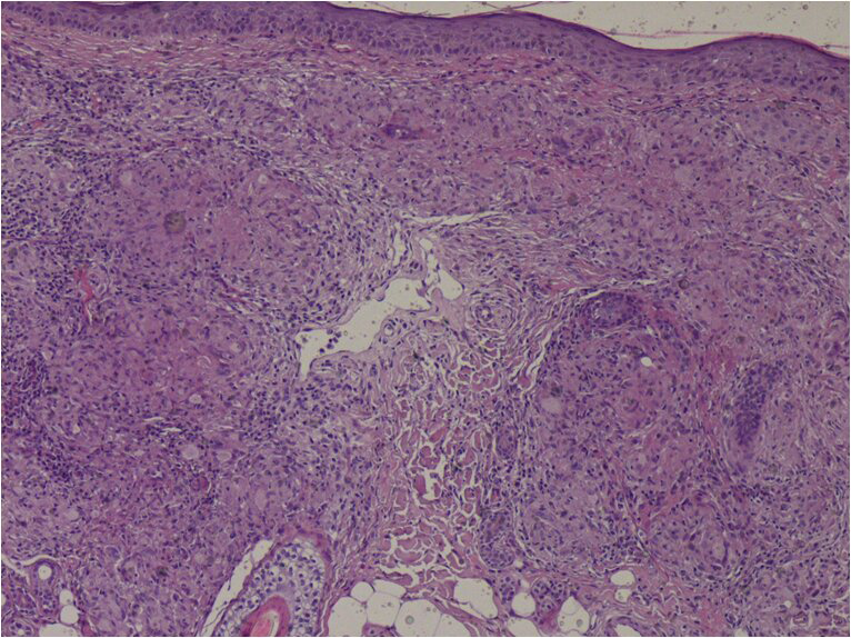 Non-caseating epithelioid granulomas in the dermis (HE ×200)