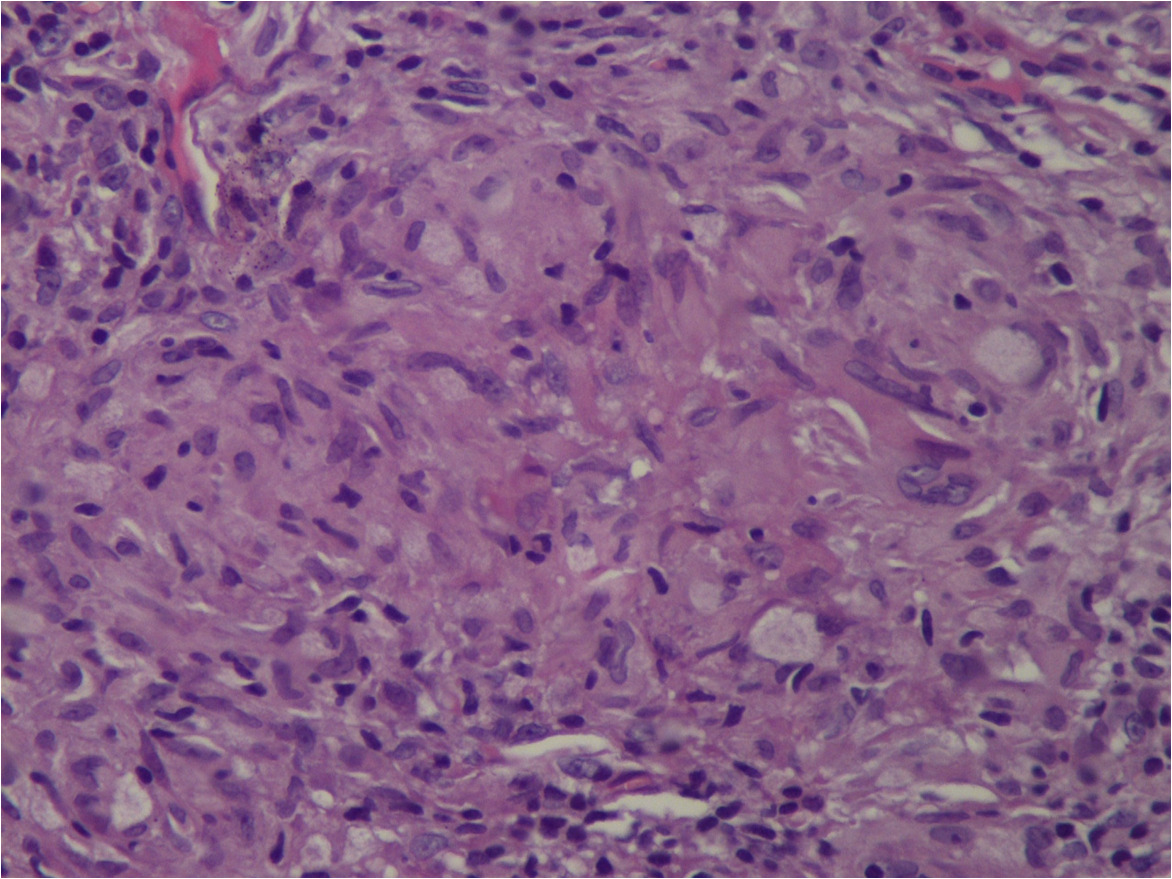 Sarcoid granuloma composed of epithelioid histiocytes and multi-nucleated giant cells (He ×400)