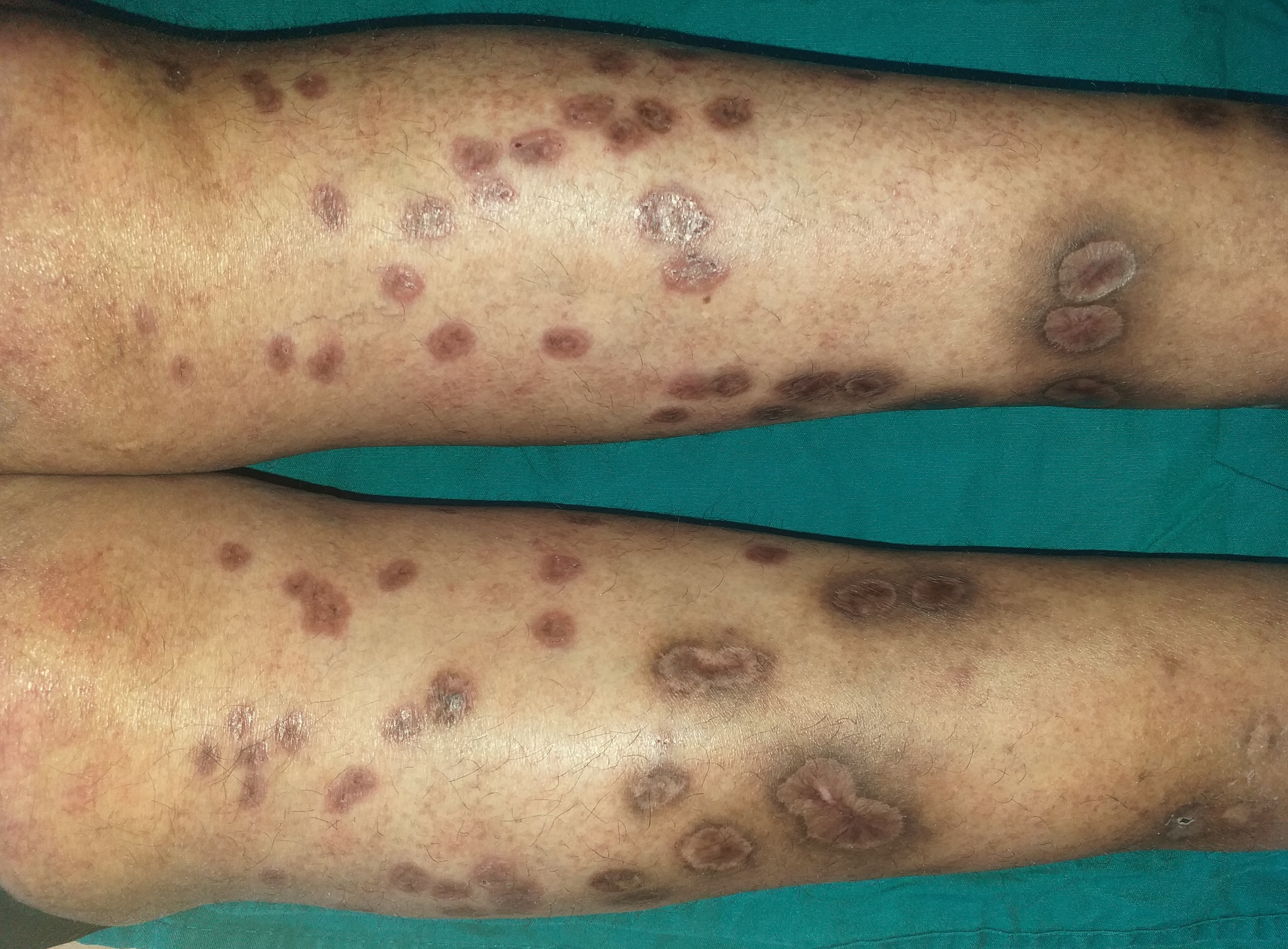 Healing ulcers of the legs after 3 months of topical treatment