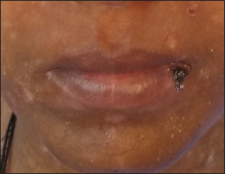 Crust at left angle of mouth, both supra clavicular region and irregularly linear hypopigmented patches and macules on face and neck