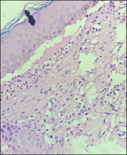 Histopathology of skin; subepidermal cleft with proteinaceous material with neutrophils and eosinophils. Moderate infiltrate of lymphocytes, eosinophils and histiocytes in superficial dermis (H&E stain, ×400)