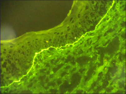 Direct immunofluorescence study of biopsy from perilesional skin; strong IgG and weak IgA deposits along the basement membrane (FITC, ×200)