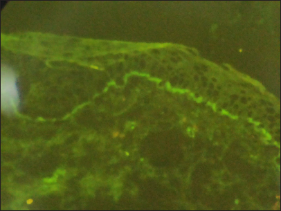 Indirect immunofluorescence study on salt split skin; strong IgG and weak IgA deposits on the floor of the blister. (FITC, ×200)