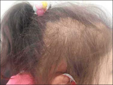The first clinical presentation of the girl with traction alopecia