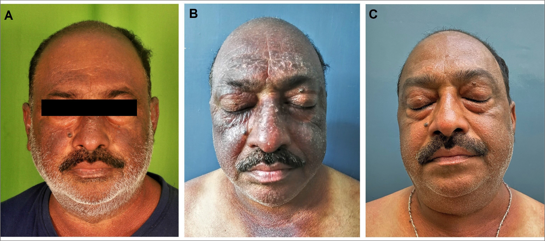 (A) Index case of chronic actinic dermatitis showing eczematous plaques over forehead, malar area, ear helix and V area of neck. The upper eyelid and nasolabial fold are characteristically spared. (B) Clinical presentation prior to starting tofacitinib therapy, shows exacerbation with increased erythema and scaling over the face. (C) Six weeks post-tofacitinib there has been significant improvement in erythema, scaling and lichenification.