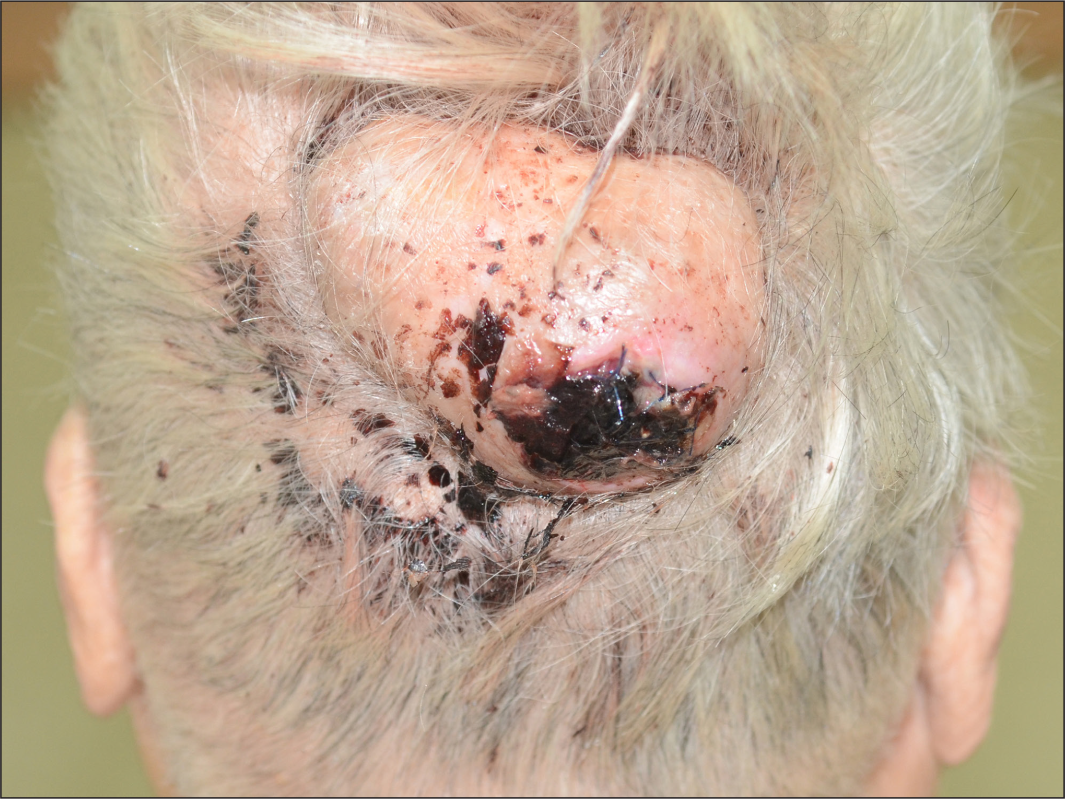 A flesh-coloured, dome-shaped mass (8 × 5 × 3.5 cm) with ulceration and haemorrhagic crusting in the occipital region