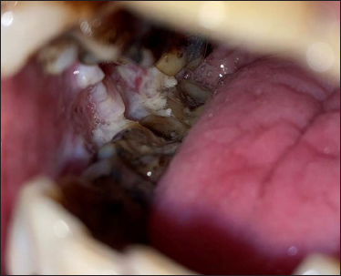 Exuberant, warty and papillomatous lesion, mostly involving the oral cavity
