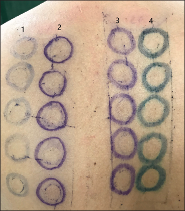 Markings on 2nd day (72 hours of patch test application) showing faded permanent pen markings