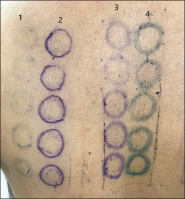 Markings on 3rd day (96 hours of patch test application) showing almost complete fading of permanent pen markings
