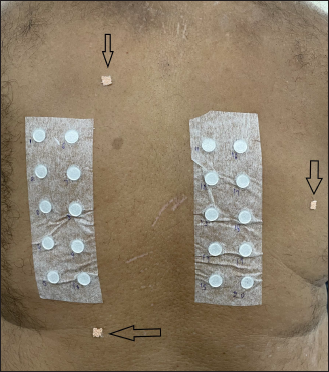 In case of the non-availability of moles/scars, create artificial landmark by sticking adhesive elastic tape (arrow) outside the patch