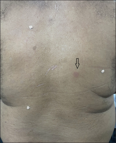 One positive reaction (arrow) after 30 minutes of patch removal; note that marking is not done on the patient’s skin