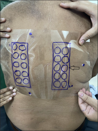 Marked overhead projector transparency sheet is applied to the patient’s back, according to marks of artificial landmarks. This helped in the identification of positive test site