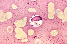 Leishmania donovani in a bone marrow cell