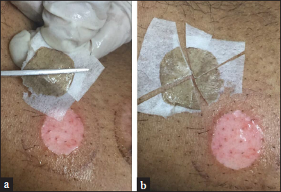 The epidermal graft is resized/cut into four pieces