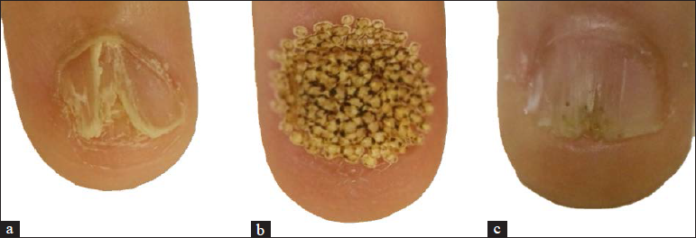(a) Fingernail showing longitudinal ridge with splitting of nail plates. (b) The whole nail plate including 1–2 mm of surrounding periungal skin was treated with fractional carbon dioxide laser. (c) Improvement in the longitudinal ridges and rough texture after six sessions of fractional carbon dioxide laser therapy in combination with a topical diflucortolone valerate 0.3% ointment