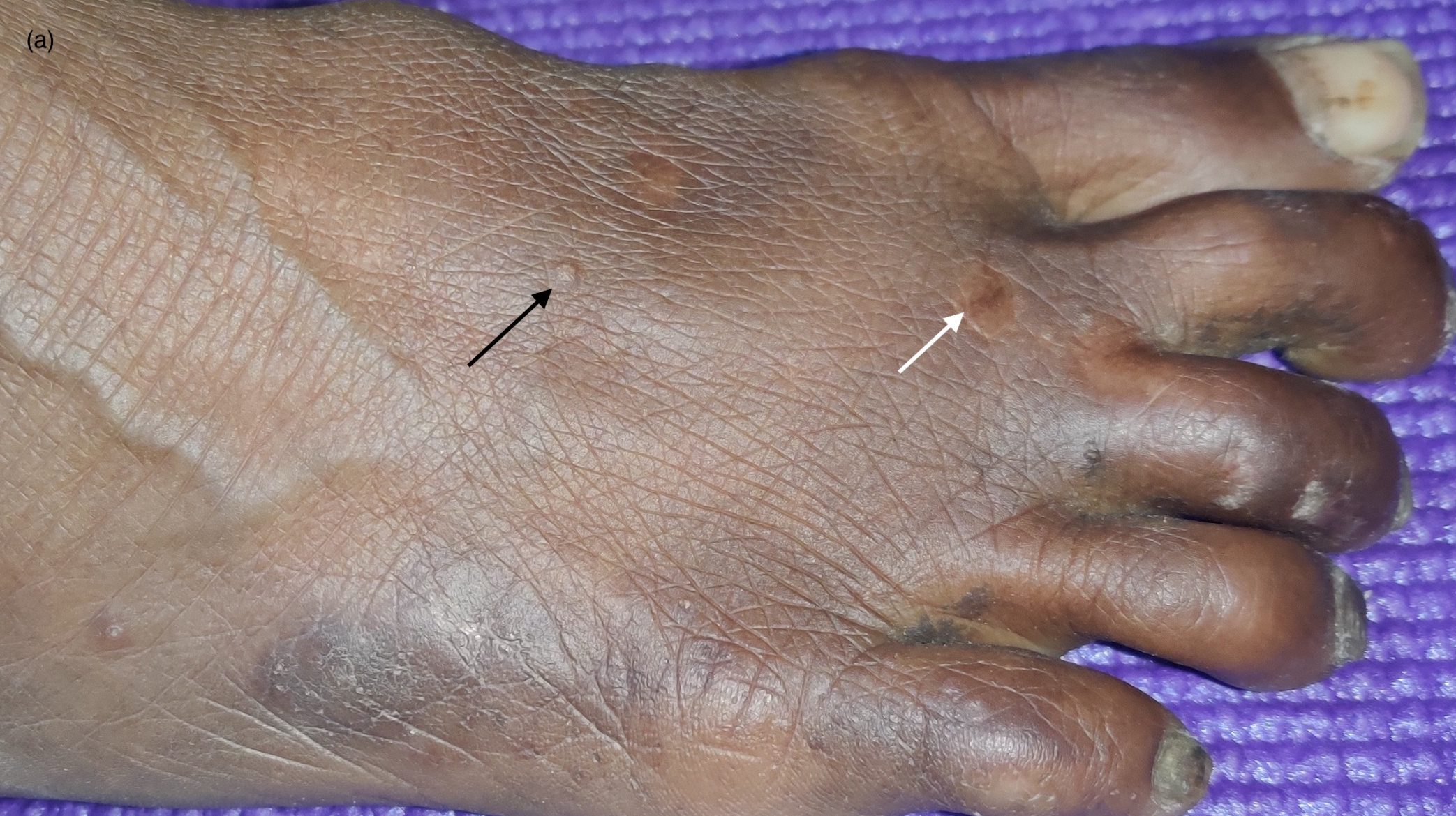 Partial subsidence of warts with scarring (white arrow) and few remnant warts (black arrow) over the right foot