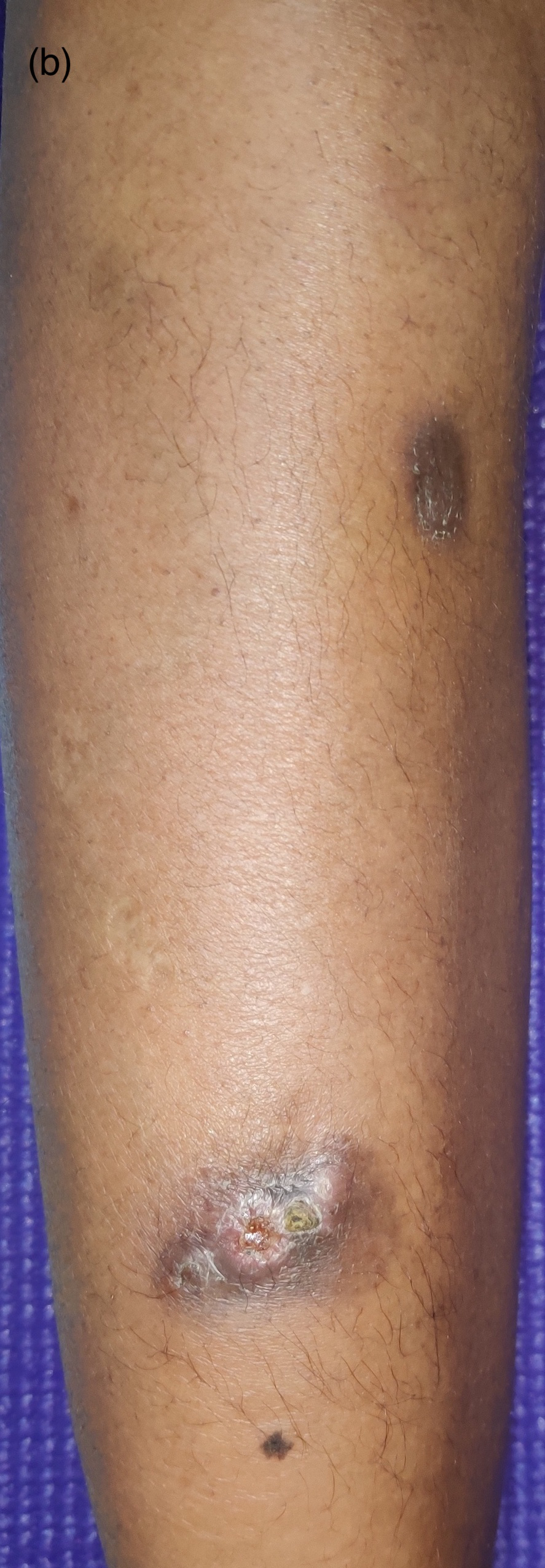 Two fluctuant abscesses over the right leg