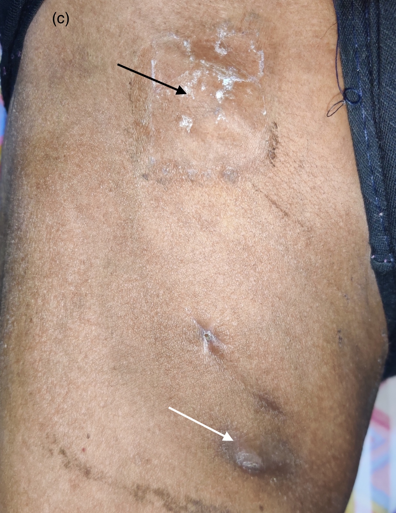 Two sinuses over the thigh (white arrow) with enlarged inguinal lymph node (black arrow)