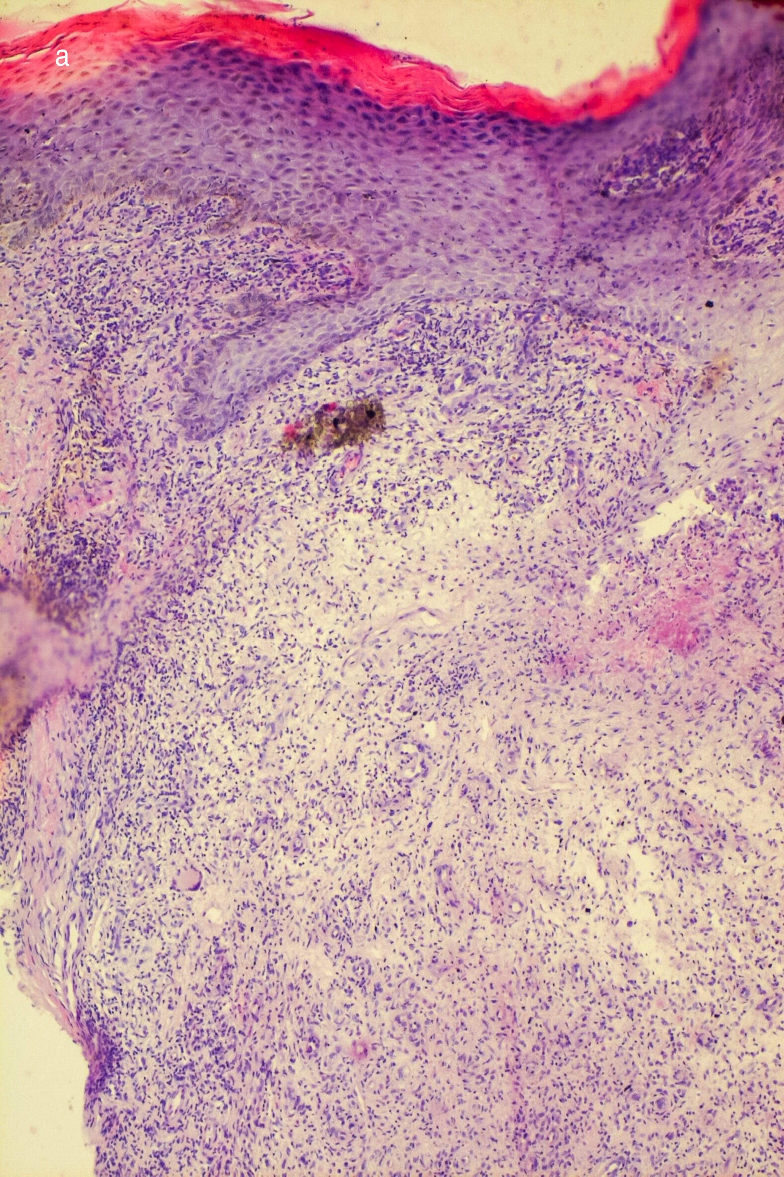 Epidermal hyperplasia and upper dermal granulomatous infiltrate with giant cells (hematoxylin and eosin 100×)