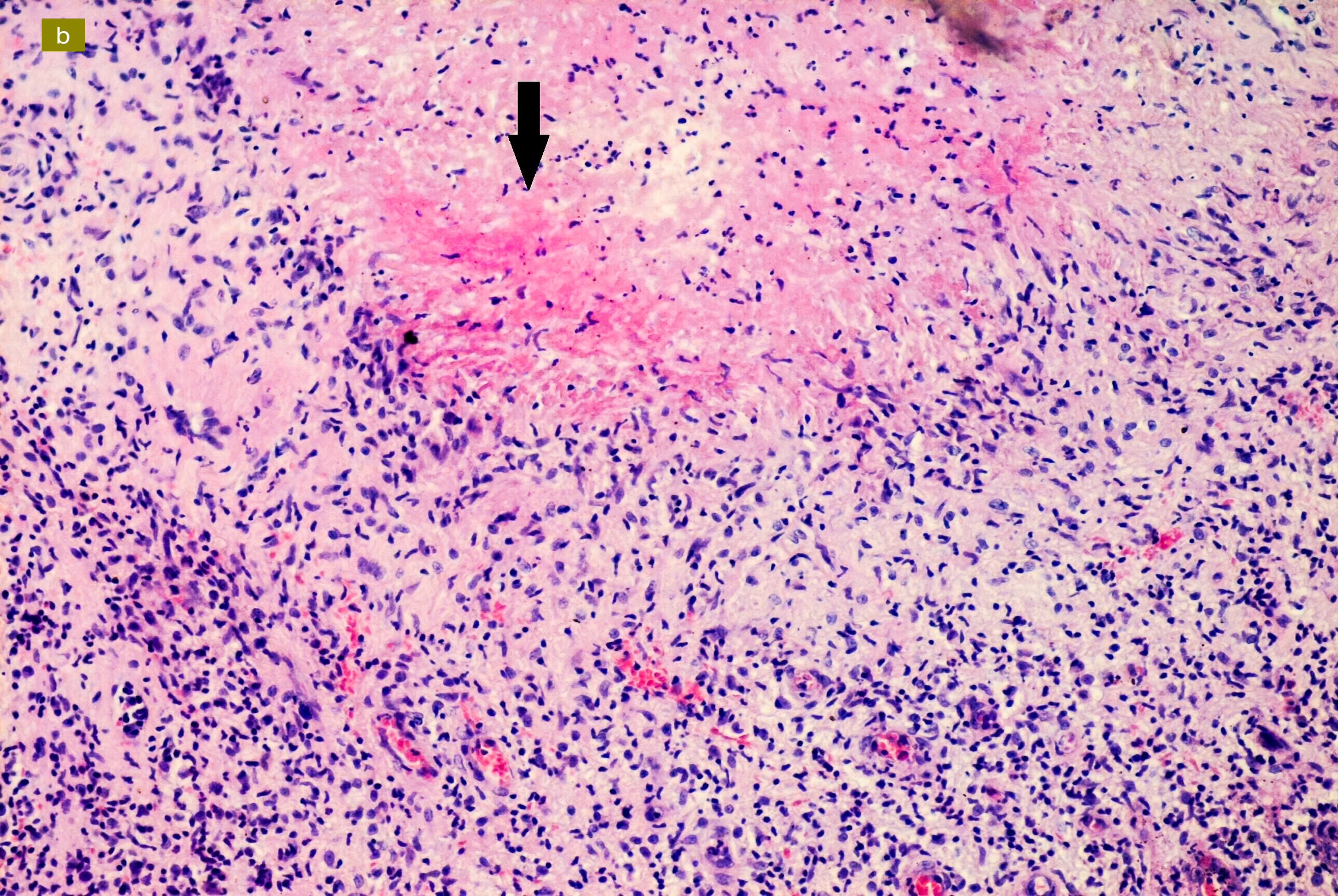 Caseating necrosis (arrow) (hematoxylin and eosin 400×)